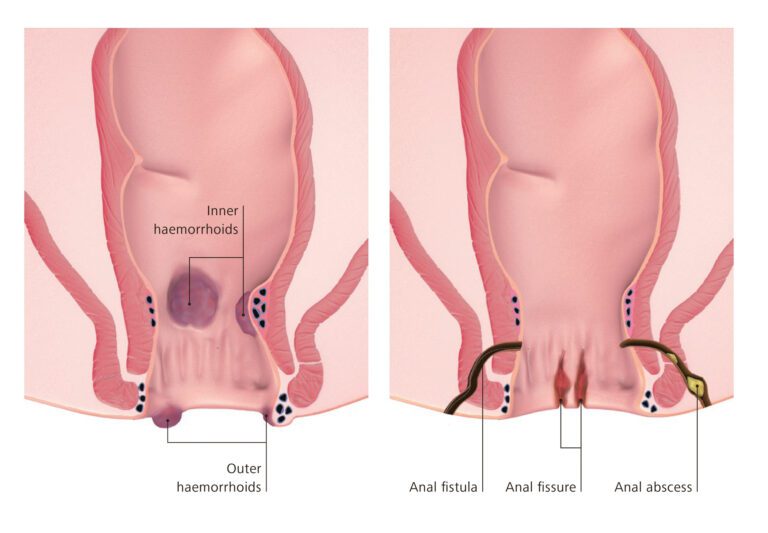 hemorrhoids-vs-anal-fissures