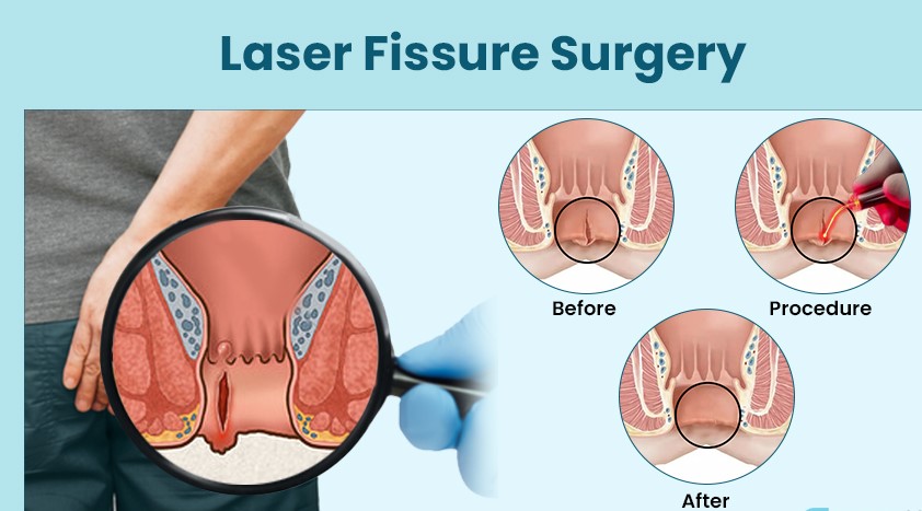 Laser Fissure